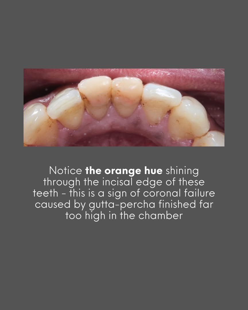 aboutDent's tweet photo. 42% of lower incisors have a second canal… and it’s easily missed.🤔

The lingual canal in lower incisors is one of those anatomical realities that doesn’t get enough airtime. It’s not rare (it’s present in nearly half of these teeth) but it’s easy to overlook if your access cavity isn’t designed to hunt for it🔍

For the lateral incisor (primary treatment), the access cavity was smaller and deliberately biased towards the incisal edge. That positioning isn’t arbitrary and it increases the chance of finding the lingual canal🎯

For the centrals (re-treatments), a more generous access was required because old composite restorations were being removed. They weren’t contributing anything structurally. Different clinical context, different access strategy, but the same goal: don’t miss the anatomy.

Six canals prepped across both teeth with .04 taper files.

Gutta-percha finished at the crestal level for a proper coronal seal.

And at 2-year recall? Stable periapical tissues, healthy clinical appearance🙌🏻📸

Missing the lingual canal is one of the most common causes of endodontic failure in lower incisors⚠️ But it’s avoidable if your access design is asking the right questions from the start.