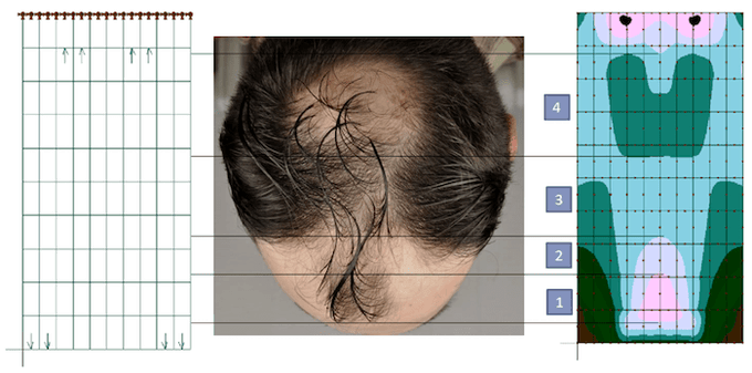 questmoosa's tweet photo. If your hairline is receding and you have NO IDEA WHAT TO DO, follow this general treatment plan or blueprint that I would use as a beginner:

- Reducing scalp tension with massage and posture/neck exercise 

- Topical work (2-3 times weekly) - topical shampoos, PRECISIONED microneedling, oils etc

- Breathing exercises (3-5 minutes daily) to reduce stress

- Fix Diet and Lifestyle (Adequate protein, carbohydrate , SFA > unsaturated fat processed seed oil, more nutrients, less anti-nutrients, more calcium in the diet, avoid endurance training, get all the vitamins & minerals etc)

- Best Supplements or Addons (Vitamin D, vitamin E, Aspirin Magnesium, coffee, blackseeds, adequate salt, redlight, peptides etc)

5 categories you need to focus on to slowdown hairline recession:

- Reducing Scalp tension (massage of scalp muscles, posture exercise) - tight scalp muscles restrict blood-flow to the hairline and crown causing a receding hairline and a baldspot overtime- study the diagram below - very important to reduce scalp tension.

- Topical work (shampoos, oils, microneedling)

- Slow breathing exercises and avoid clenching the neck and jaw muscles (clenching and fast breathing patterns increase pressure in the skull and scalp tension)

- Diet and lifestyle

- Supplements and "add-ons"

Follow this and optimise these 5 categories I don't see why you need to panic about your receding hairline or baldspot for even another SECOND.