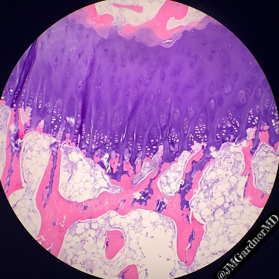 JMGardnerMD's tweet photo. What is this structure? What process is happening? How old is this patient?
Answers &amp; pics w labels: https://t.co/5US7kmm4gK
Video: https://t.co/Bu63RPwr2u 
#BSTpath #pathologists #pathology #pathTwitter #histology #orthotwitter #pedstwitter #medtwitter https://t.co/D23xnUCZ1t