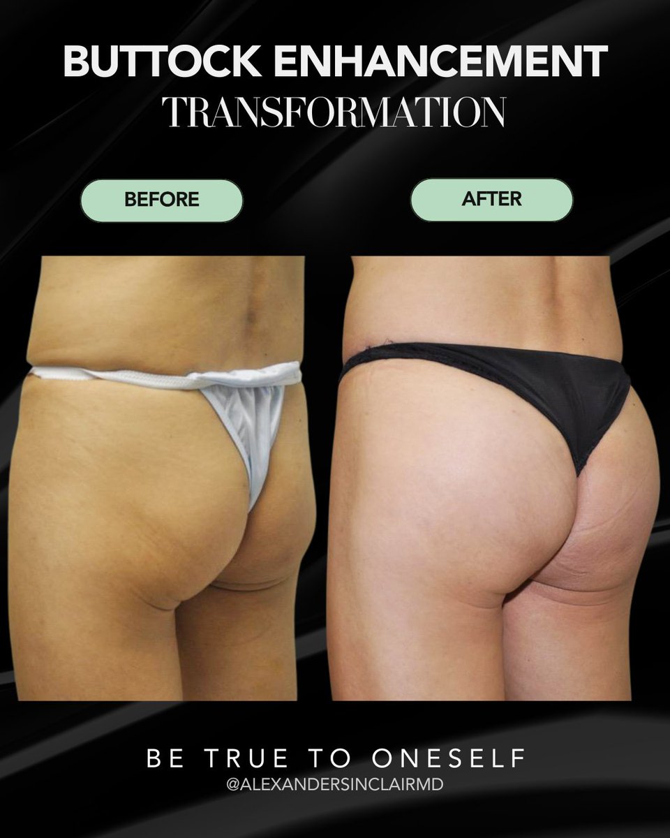 agentofchangemd's tweet photo. Age is just a number, confidence is timeless. ✨

This 52-year-old patient underwent buttock enhancement with silicone implants to create a fuller, rounder, and more balanced silhouette. 

Schedule a consultation: https://t.co/7iT9SaAX4m! https://t.co/wdp3AeS4Si