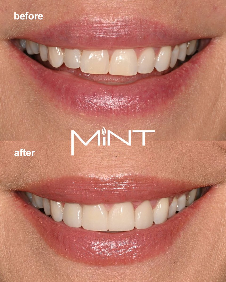 MINTdentistry's tweet photo. Look at this subtle shift in shape, symmetry, and brightness achieved with MINT Veneers. 

#mintveneers #veneers #explore #beforeandafter #sexyteeth #mintdentistry https://t.co/tzdiJLZKoo