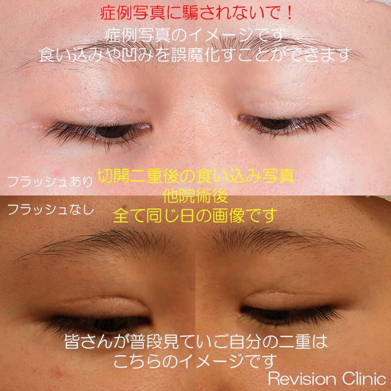 InfoIkb's tweet photo. ＜切開二重は罪な術式＞
みなさん症例写真に騙されないでください！
「傷跡が綺麗」とか言っても本当のところはどうなんでしょう？
1枚目の写真は他院切開二重後の写真です。
フラッシュありの症例写真では傷跡の本当の汚さは誤魔化されてしまいます。
フラッシュなしで撮影した画像が普段皆さんが見ているご自分の二重になります。
食い込みと陥凹が目立ちますね。
2枚目の画像が二重修正前後（右目）です。
名付けて「生まれつきの様な二重修正」
フラッシュなしでもこの改善度はまさにリビジョンクリニック・クオリティです
本モニター様は過去複数回の修正手術により写真の様な状態になり、メンタル面もかなり参っていました。症例写真を掲載するかどうか悩みましたが、二重の食い込みに悩む方のためにお写真を提供していただきました。
ありがとうございました。
食い込み修正後、ご家族ともども大変喜んでおられますが、3ヶ月が経過した現在もなお不安が完全になくなることはまだない様です。
切開二重とは罪な手術ですね。
さあ、みなさん。
どのクリニックで切開しますか？
モニター様は今後も修正後の経過、メンタル、全力で支えていきます！