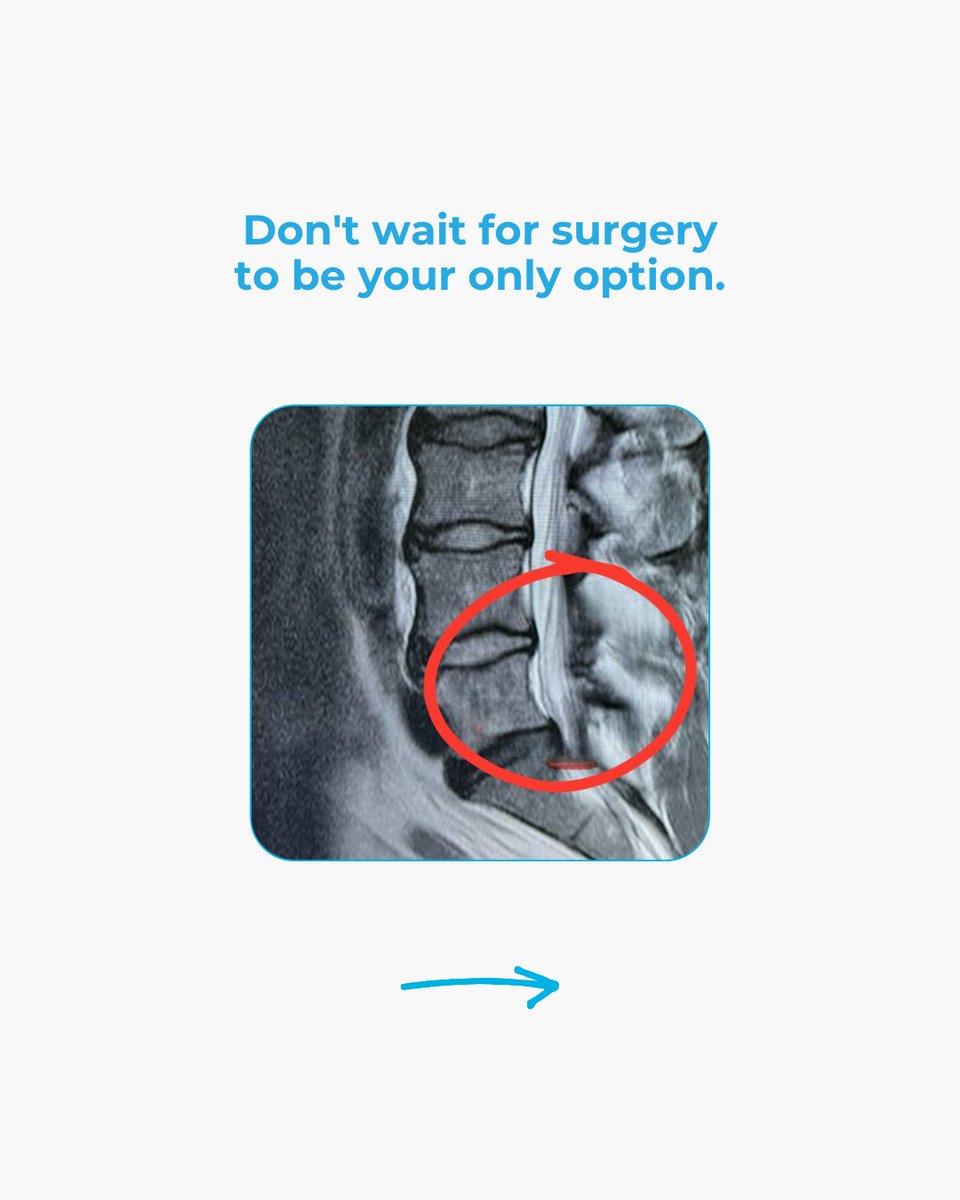 JDchiro's tweet photo. You don’t need surgery… you need to fix the pressure.
DM “RELIEF”
#backpain #herniateddisc #spinaldecompression #sciaticarelief #nosurgery https://t.co/jJctUXJhMi