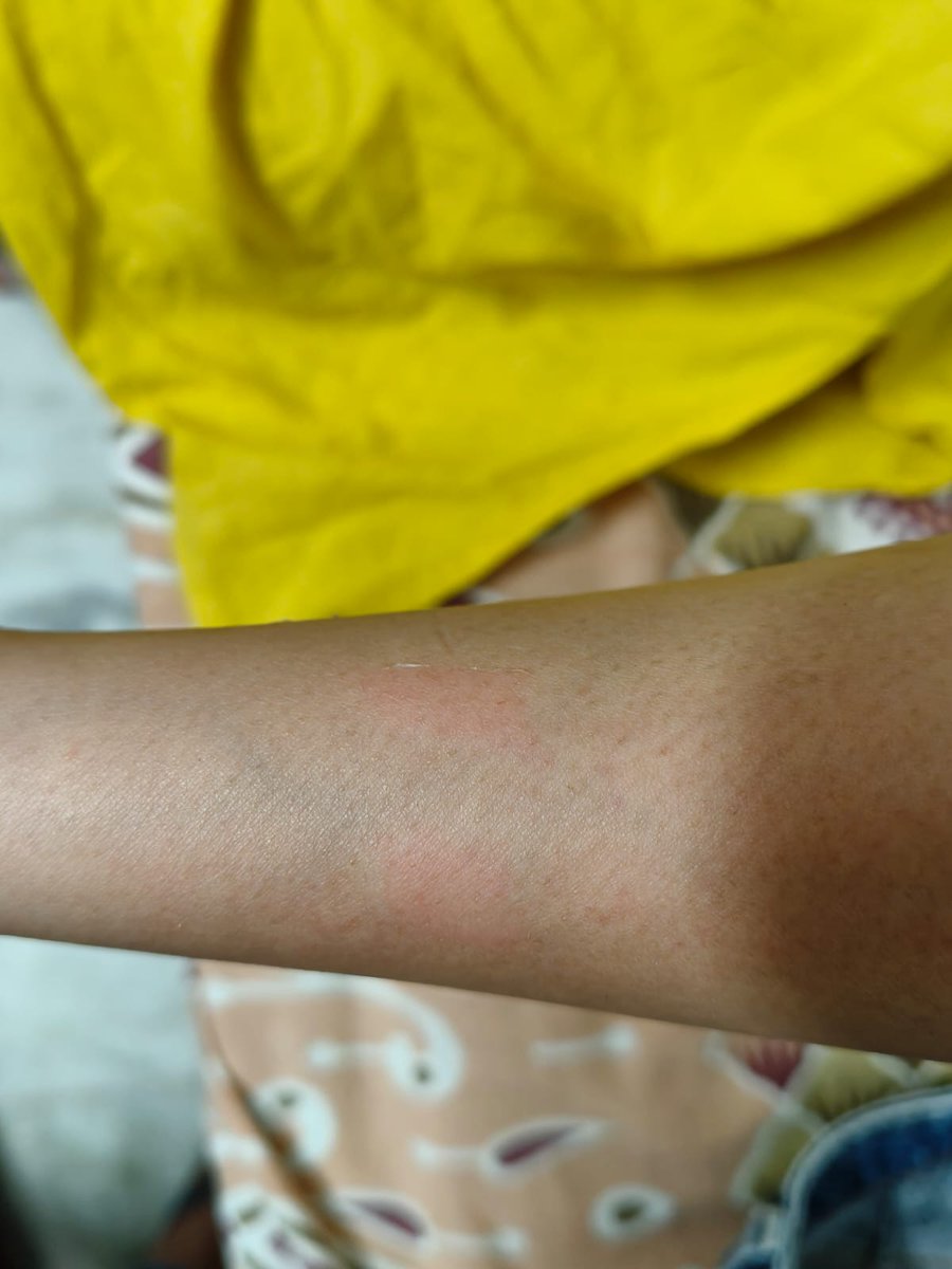 JSinsi02's tweet photo. @LooksIndia My friend got first degree burns on her hands and legs today at your Omaxe Chowk Mall location. The beautician Ms. Zoya was made aware that temperature feels a bit high but she continued without concern for the customer. Is this how you are running the show? https://t.co/z4jFdgOkU0