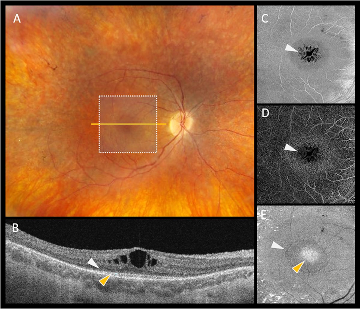 AAOjournal's tweet photo. Cystoid Macular Edema in Retinitis Pigmentosa: Pathophysiologic Insight Using Swept-Source Optical Coherence Tomography and Angiography
https://t.co/VTEHUAYyZD
#ophthalmology https://t.co/c1r4GMal3C