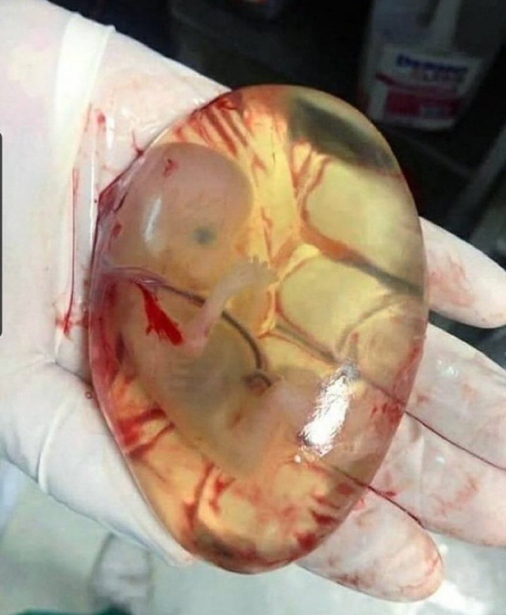 A case of miscarriage with the fetus still in its intact amniotic membrane {En caul}.