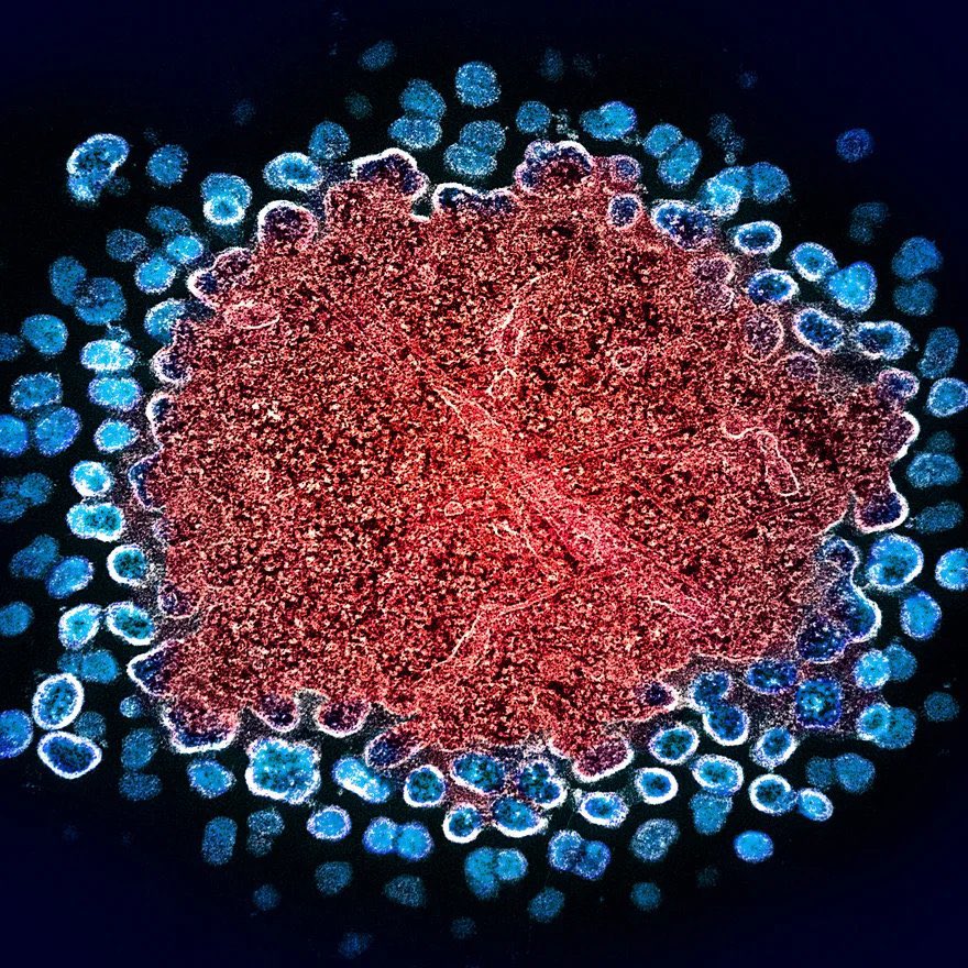 scitechgirl's tweet photo. 🚨Just In: In Norway, a patient has been completely cured of HIV thanks to a stem cell transplant from their sibling for Leukemia treatment. https://t.co/y7NolomdRO