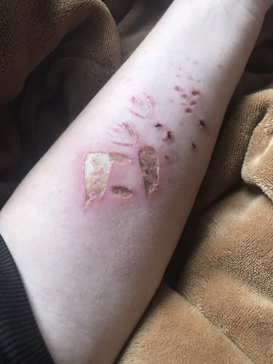 Bird08889112925's tweet photo. Day 7
Last healing update for these
#burntwt #scabs #sh https://t.co/HCWDh9FvtZ