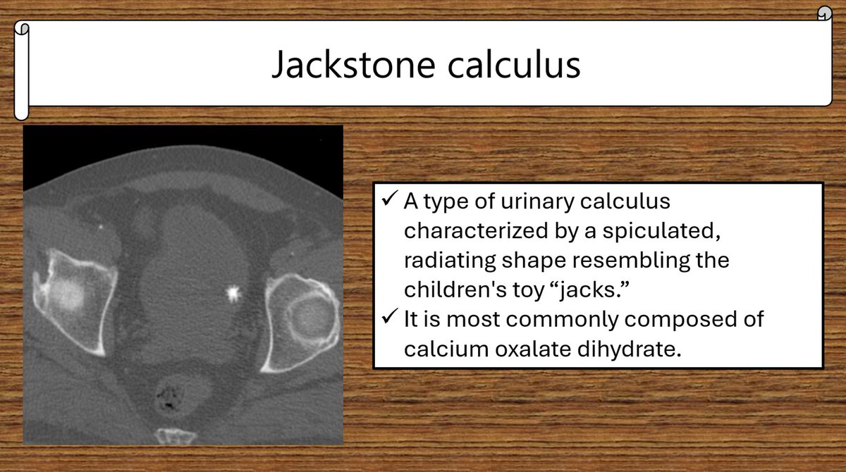 Jackstone calculus 尿路結石の一型で、子どもの玩具の “jacks” のよう