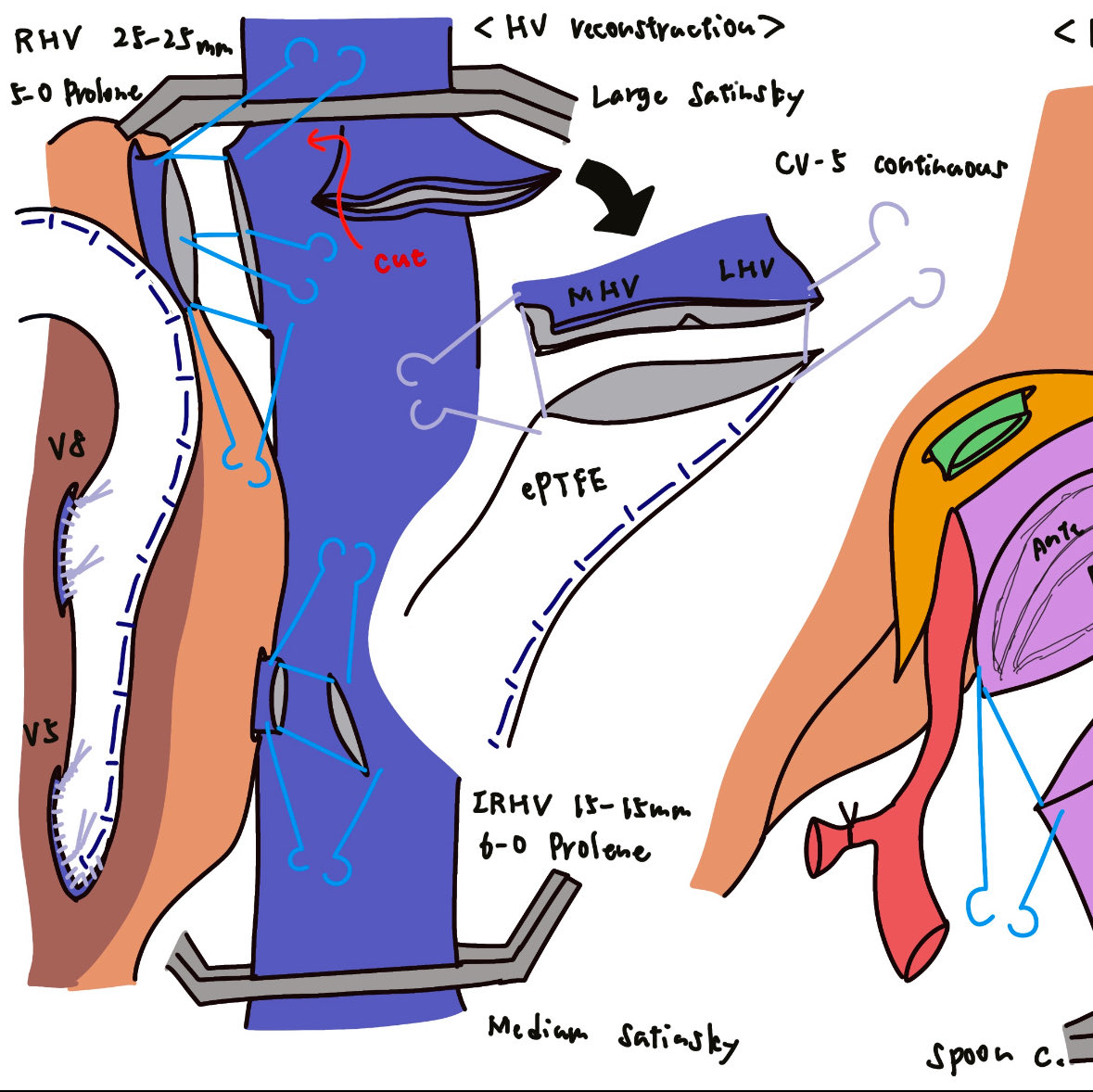 ToruGotoMD's tweet photo. My signature technique, multiple hepatic vein reconstruction https://t.co/BTz0Rlk6y7