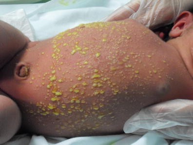 drsthanus's tweet photo. Neonate on day one with no systemic symptoms. 

Diagnosis? https://t.co/2xUtHsBaoB
