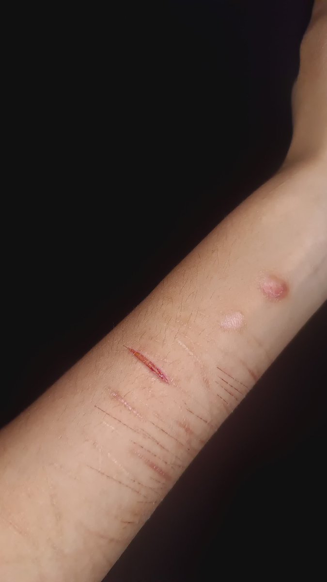 tw:sh, sangue

cortezinhos fofos do ano passado +queimadura de cigarro q meu ex apagou em mim #shedtwt #shtwt #babycut
