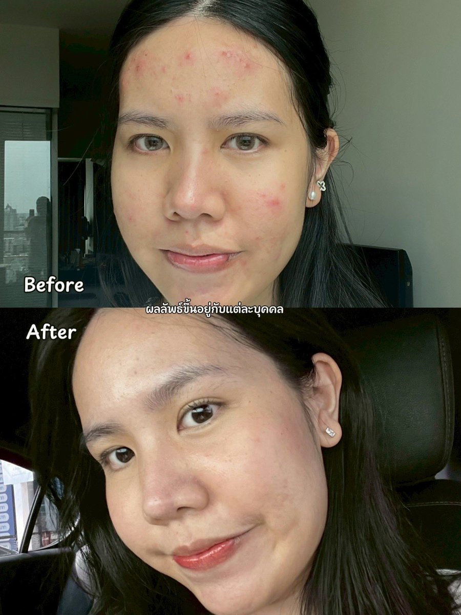 PJSahutsaya's tweet photo. บอกเลยว่าช่วงที่สิวเห่อหนักๆ รอดจากสิวมาได้เพราะ Eucerin นี่แหละ คือช่วงนั้นไปเจอมลภาวะมาแบบหนักมาก เลยลอง Gel to Foam ตัวใหม่สูตรอ่อนโยนกว่าเดิม พอใช้คือ รู้สึกเลยว่าสิวมันไม่ค่อยอักเสบเพิ่ม แล้วก็ไม่เห่อขึ้นเหมือนแต่ก่อนเป็นตัวช่วยในการคุมสิวได้ดีมาก ล้างแล้วหน้ายังชุ่มชื้นอยู่ คือเริ่ดๆๆๆ แนะนำให้ไปลอง!