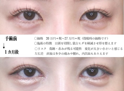 drmatsui's tweet photo. ヒダを減らす。
目頭切開で蒙古ヒダを減らし、切れ長の目を実現する。
そういった効果がわかりやすい一例。
更に傷が落ち着いていくのを待ち、経過を見ていきます。
＃目頭切開 https://t.co/zTHSnsLUFe