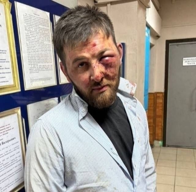 УДАР с ноги!
На фото вахабит вымогавший деньги у русских ветеранов СВО и их семей, после встречи со спецназом в Москве.
