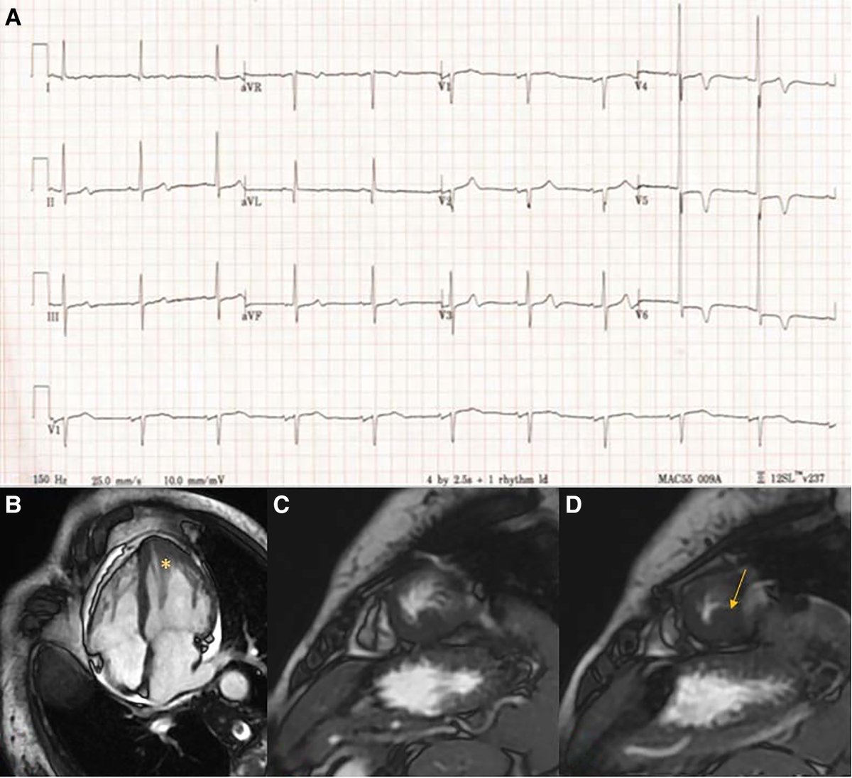 ESC_Journals's tweet photo. Papillary muscle abnormality as an electrocardiographic mimicker of apical hypertrophic cardiomyopathy: giant T-wave inversions are not always HCM—CMR is key to avoid misdiagnosis and overtreatment 🧠 https://t.co/aKNcerwTGR

#EHJCaseReports @Phiso_de @TJ_Yeo @aayshacader @BoldiKovacsMD @SukritiBanthiya @O_Azizy_MD @saramoscatelli7 @EHJCREiC #CardioX
