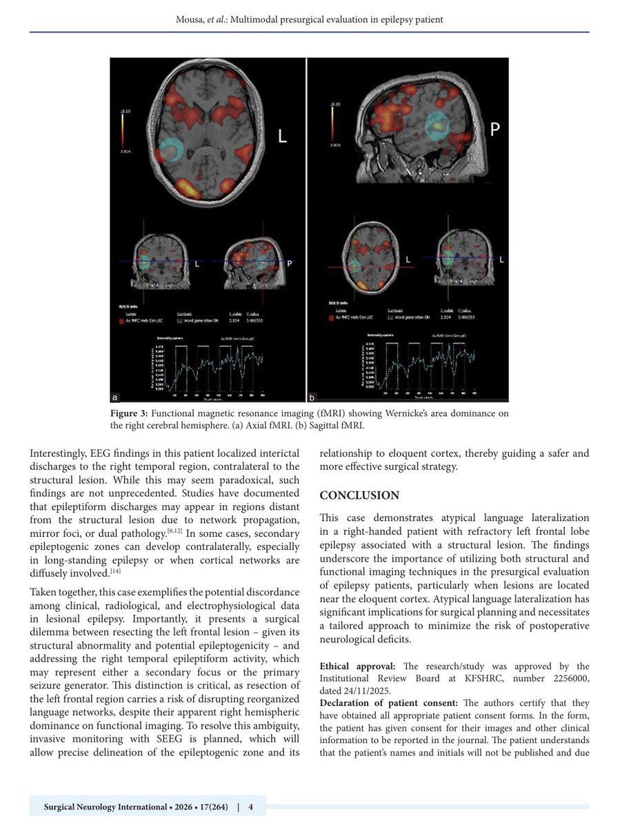 badr_hafiz_'s tweet photo. Check out our latest publication in Surgical Neurology International @SNInt:

“Atypical Language Lateralization and Contralateral Epileptiform Activity in a Right-Handed Patient with a Left Frontal Cortical Lesion: A Multimodal Presurgical Evaluation”

🔗 Link: https://t.co/iU0pGeo6ug

🔹In this case report, we present a unique presurgical epilepsy evaluation highlighting atypical right-hemisphere language dominance in a right-handed patient with a left frontal cortical lesion, emphasizing the importance of multimodal assessment in epilepsy surgery planning.

🔹Key insights:
• Functional MRI demonstrated atypical right-sided dominance for both Broca’s and Wernicke’s areas
• EEG revealed contralateral right temporal epileptiform activity despite a left frontal lesion
• Multimodal integration of imaging and electrophysiology was critical for individualized surgical planning

Special thanks to Dr. @Afnan_Alkhotani for her continuous support and mentorship throughout this work.

#Neurosurgery #Epilepsy #fMRI #EEG #EpilepsySurgery #BrainTumor #Neuroimaging #LanguageLateralization #SurgicalNeurology #Research
#Neurology