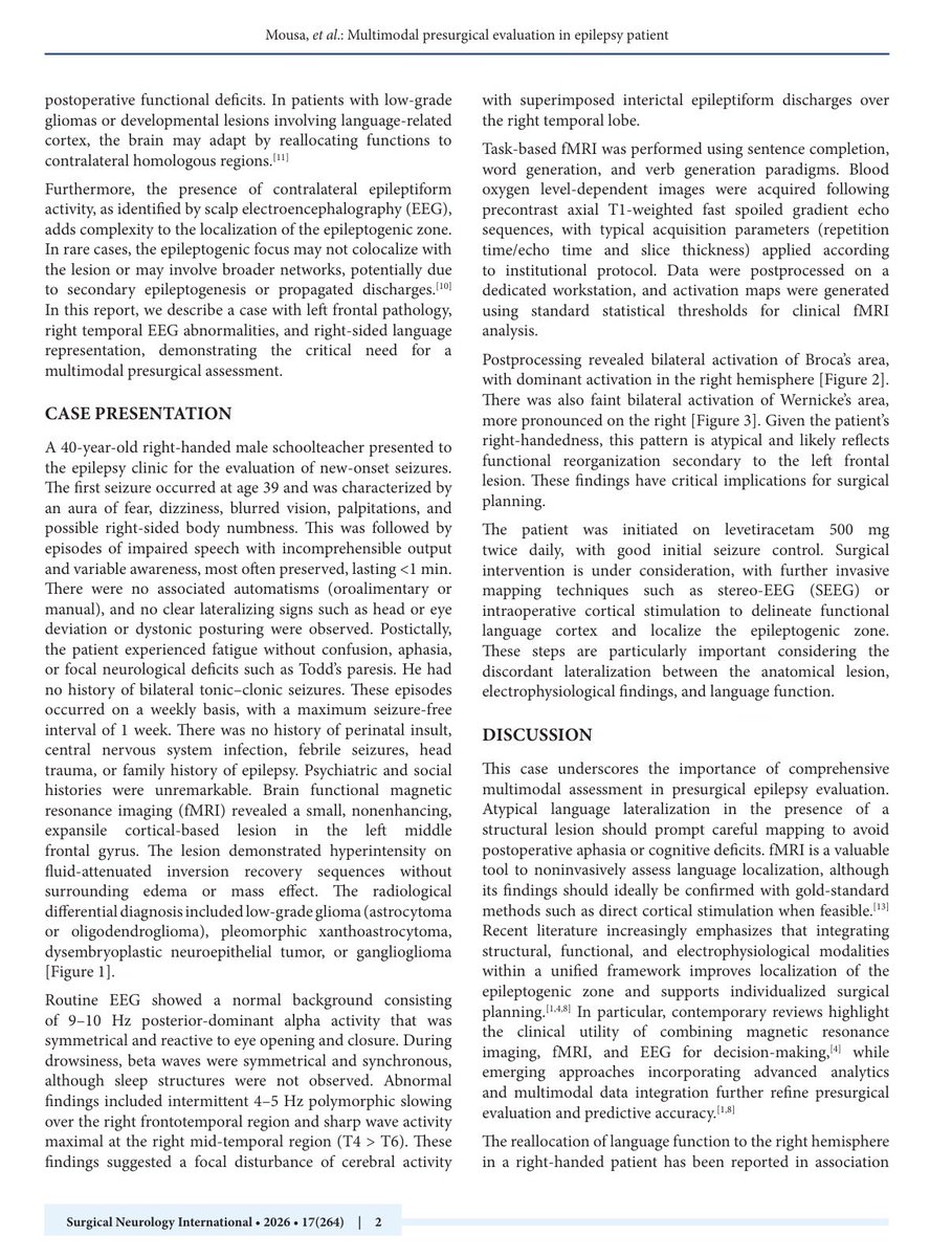 badr_hafiz_'s tweet photo. Check out our latest publication in Surgical Neurology International @SNInt:

“Atypical Language Lateralization and Contralateral Epileptiform Activity in a Right-Handed Patient with a Left Frontal Cortical Lesion: A Multimodal Presurgical Evaluation”

🔗 Link: https://t.co/iU0pGeo6ug

🔹In this case report, we present a unique presurgical epilepsy evaluation highlighting atypical right-hemisphere language dominance in a right-handed patient with a left frontal cortical lesion, emphasizing the importance of multimodal assessment in epilepsy surgery planning.

🔹Key insights:
• Functional MRI demonstrated atypical right-sided dominance for both Broca’s and Wernicke’s areas
• EEG revealed contralateral right temporal epileptiform activity despite a left frontal lesion
• Multimodal integration of imaging and electrophysiology was critical for individualized surgical planning

Special thanks to Dr. @Afnan_Alkhotani for her continuous support and mentorship throughout this work.

#Neurosurgery #Epilepsy #fMRI #EEG #EpilepsySurgery #BrainTumor #Neuroimaging #LanguageLateralization #SurgicalNeurology #Research
#Neurology