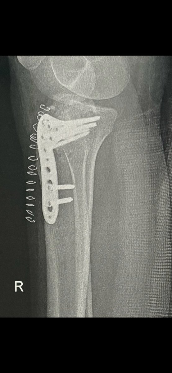 XStrayDogMumbai's tweet photo. #Gujarat- on 16 April, Sunaina was returning from office at 6.30 pm as usual, when a #straydog came dashing out of nowhere in front of her scooter, causing an #accident that fractured her knee and ankle. 6 wk #bedrest. Loss of 3 months' pay. Will #dogmafia or govt. reimburse her? https://t.co/xJJfzVh1WG