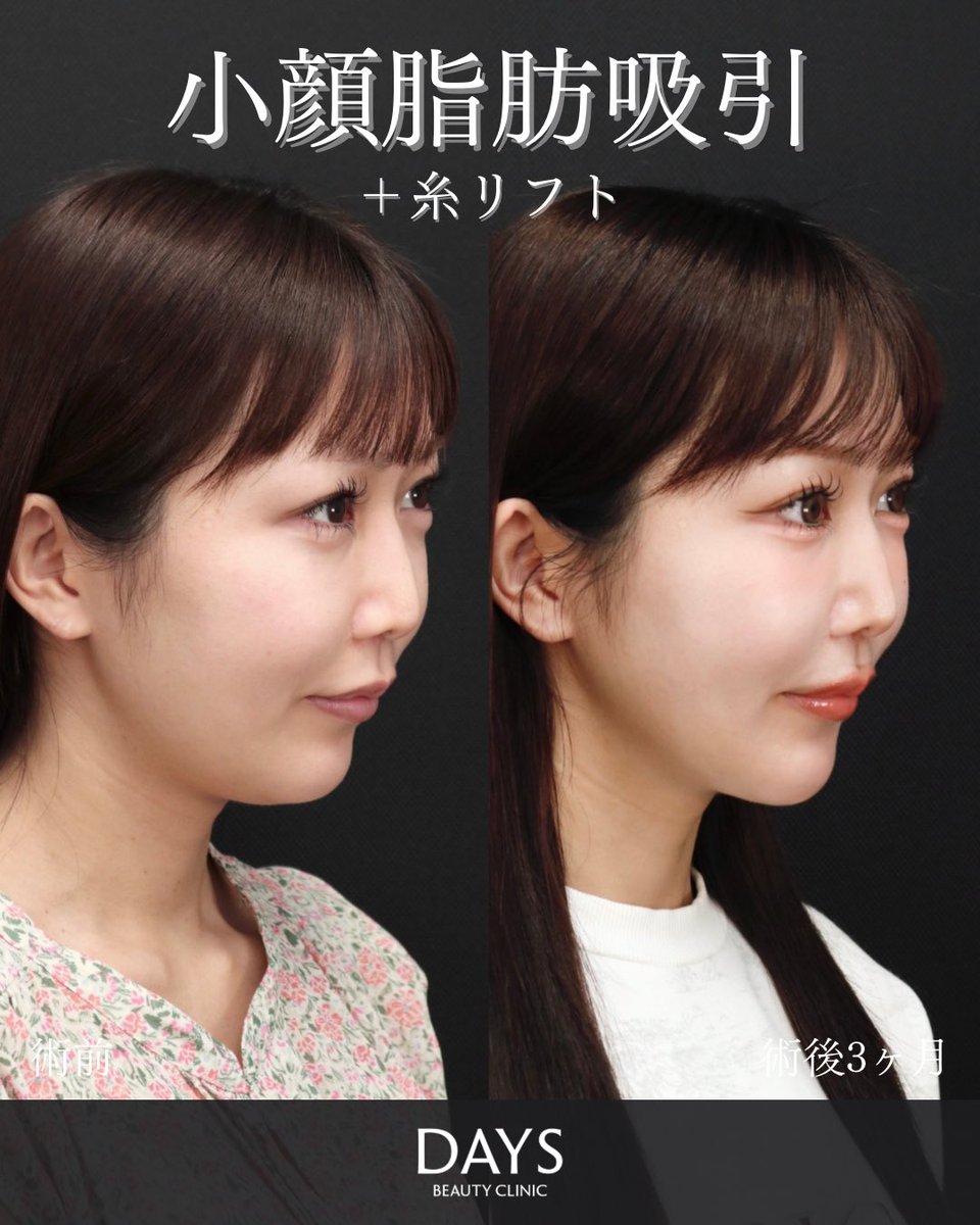 小顔整形 山野祐 tweet media