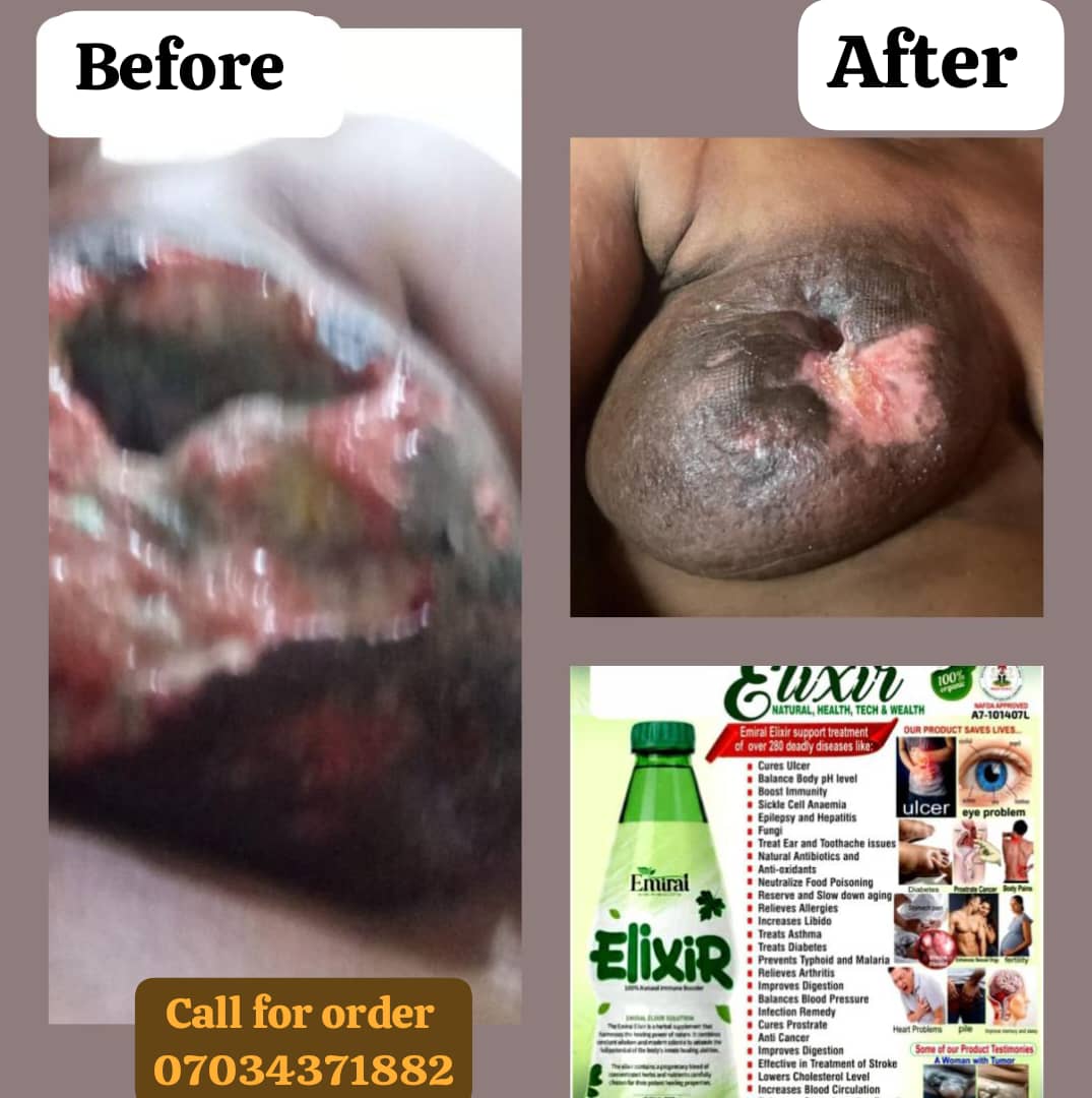 Stan7034's tweet photo. 💧 Embarrassed by Infection?

Body pains?

Ulcer?

Skin irritation?

Emiral Herbal medicine Can Help you— Naturally.

That strong, fishy smell isn’t just uncomfortable — it’s a sign your body needs help. Emiral Elixir Herbal medicine is a powerful herbal blend that fights https://t.co/4ddLDj4CLr
