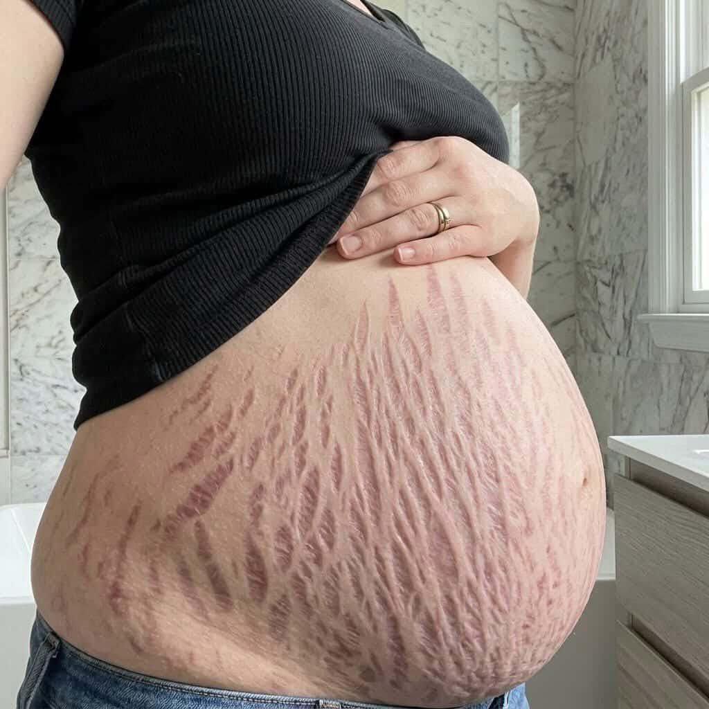 If you were pregnant and had scars like these, would you still choose to have the baby?

如果你怀孕后也会成这样，你会选择怀孕吗？ https://t.co/Rt4c4v9E6u