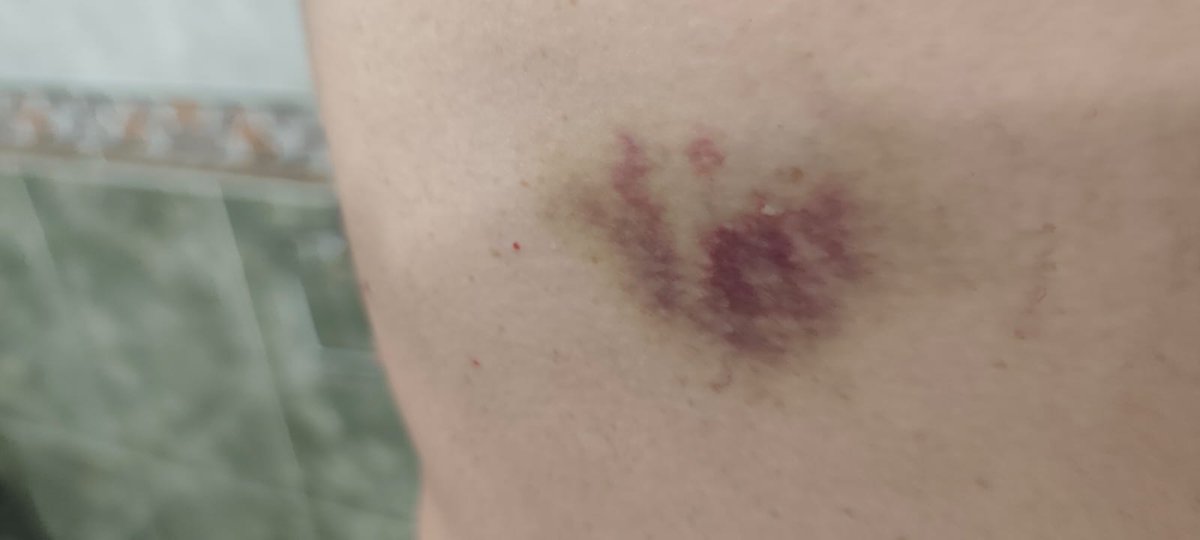 TampmDueso's tweet photo. Nueva agresión a dos funcionarios de prisiones en el C.P. El Dueso.
Un interno en estado de agresividad extrema, lesiona  a dos funcionarios.
Los compañeros presentan lesiones en rodilla y hematomas en el cuerpo.  Fueron atendidos en urgencias por la gravedad del ataque. https://t.co/e5w5UBtyIz