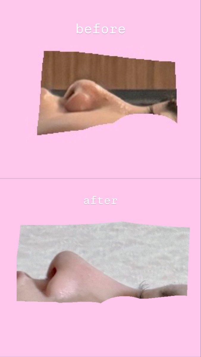 pookidooonn's tweet photo. 鼻フルから3ヶ月！！

こんな鬼低い肉厚団子鼻から忘れ鼻になりました🥹🥹🥹

ずっとコンプレックスだった��ら嬉しい😭 https://t.co/vnFwq3LOhz