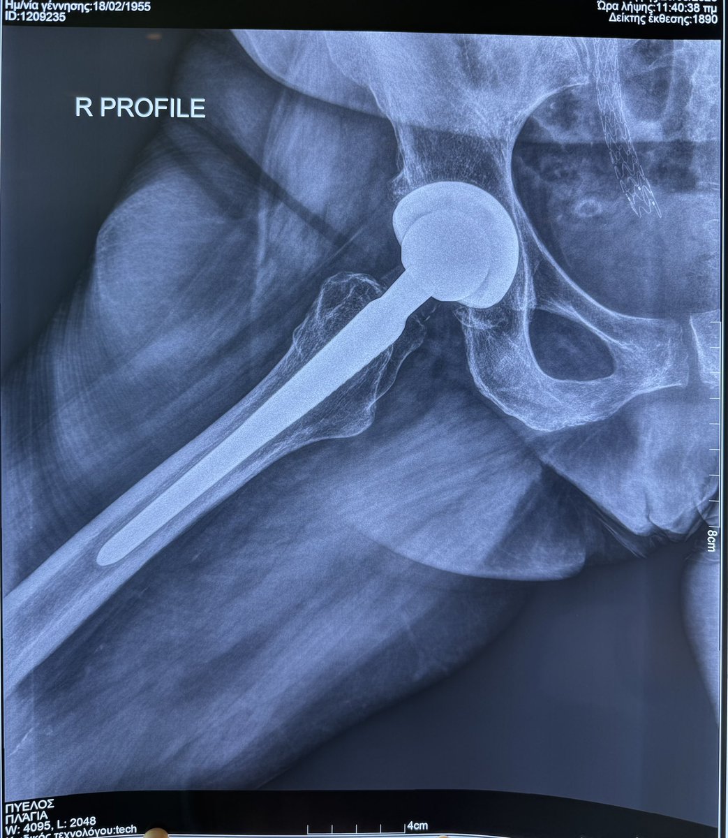 miniscocenter's tweet photo. #superpath #arthroplasty #arthritis #pain #quality #life #hip #knee #surgery #orthopedic #ortho #orthopaedic #surgeon @KostasIntzoglou https://t.co/qUjIKWexcH