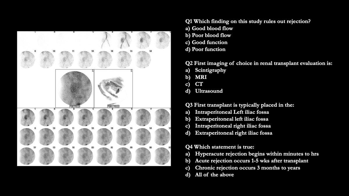 NuclearMD's tweet photo. Case Challenge: # 65

Test your skills by providing answers in comments.  Come back to check the answer key in 24 -48h. 

Get all the cases at: https://t.co/xWiTQdHGvq 
#radiology #nuclearmedicine #petctscan #nucmed #radres https://t.co/MofNgqUVkI