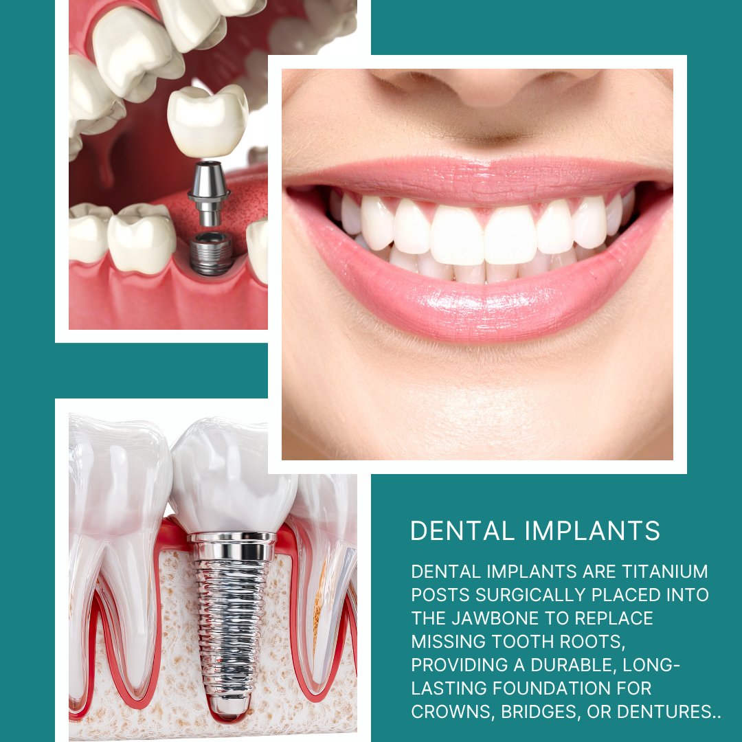 Dental implants look and feel like your own teeth and because they are designed to fuse with bone, they become permanent.

 #DentalImplants #SmileMakeover #ToothReplacement #ImplantDentistry #ValleyDental130
ow.ly/BXLM50YWBi5