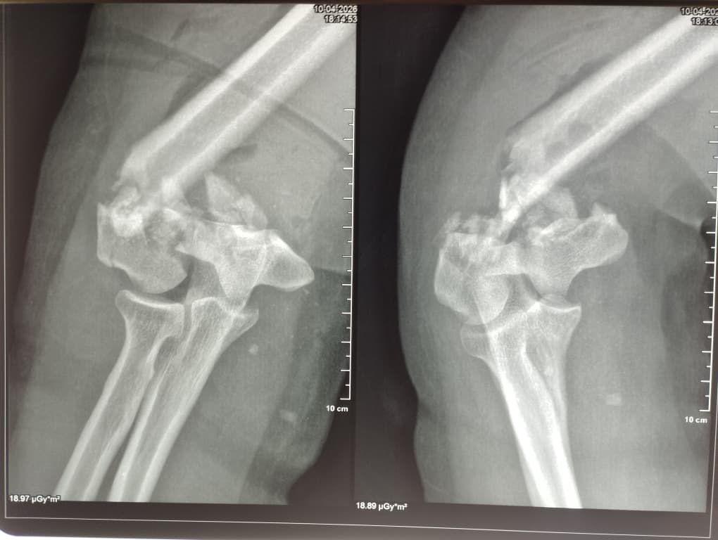 Dr_ekelle's tweet photo. A 42-year-old woman who sustained an open fracture of the distal left humerus, initially treated with debridement and a splint, and admitted 21 days later for osteosynthesis https://t.co/qNwbnGpPB8