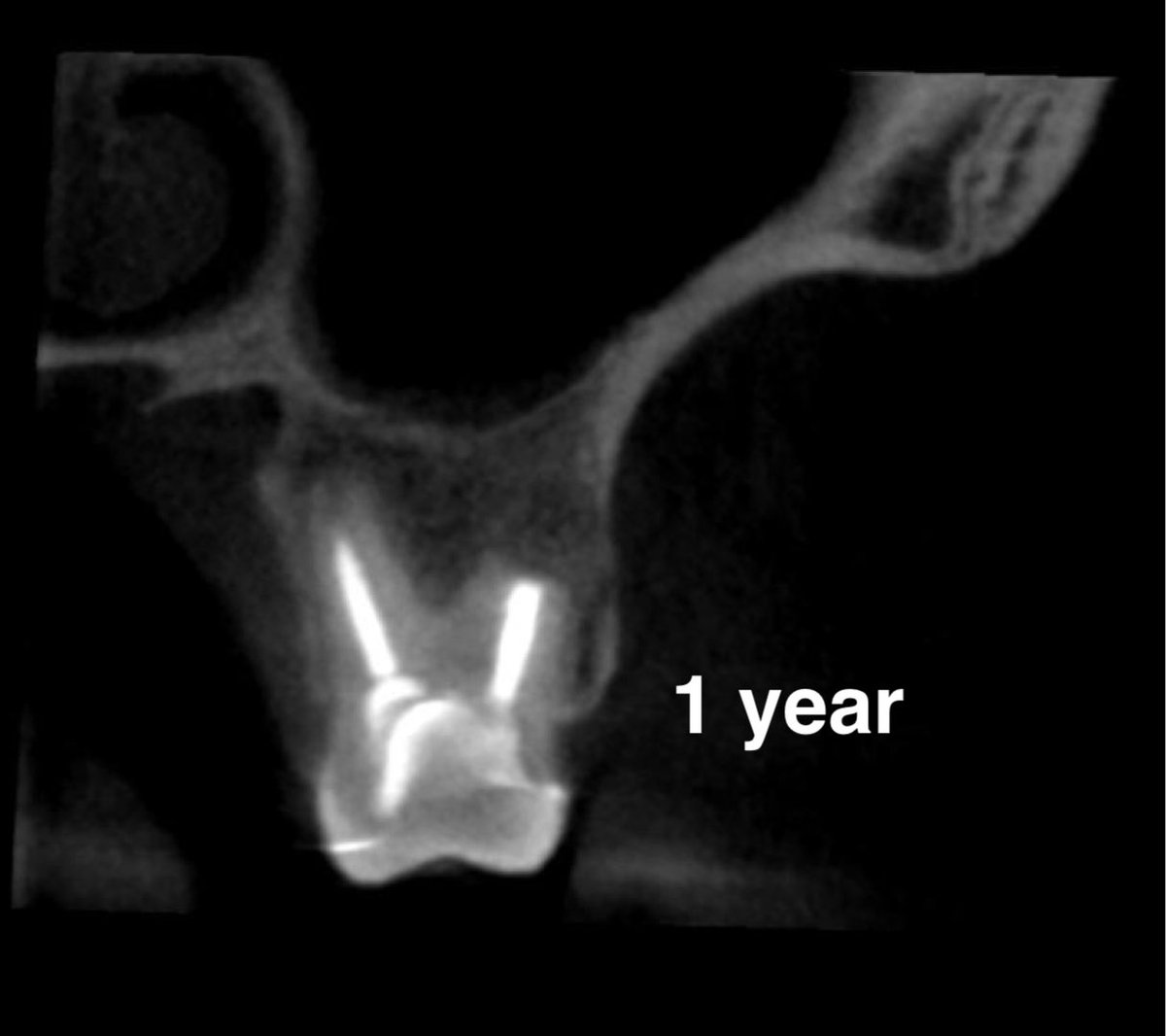 i_th44's tweet photo. #26 #Microsurgery #endodontics

- Endodontic microsurgery for iatrogenic mishaps : overfilling in the DB root with perforation into the maxillary sinus, and a separated file in the MB root engaged in the sinus floor.

https://t.co/ykBA0ARPGg https://t.co/vgAKvocWRn