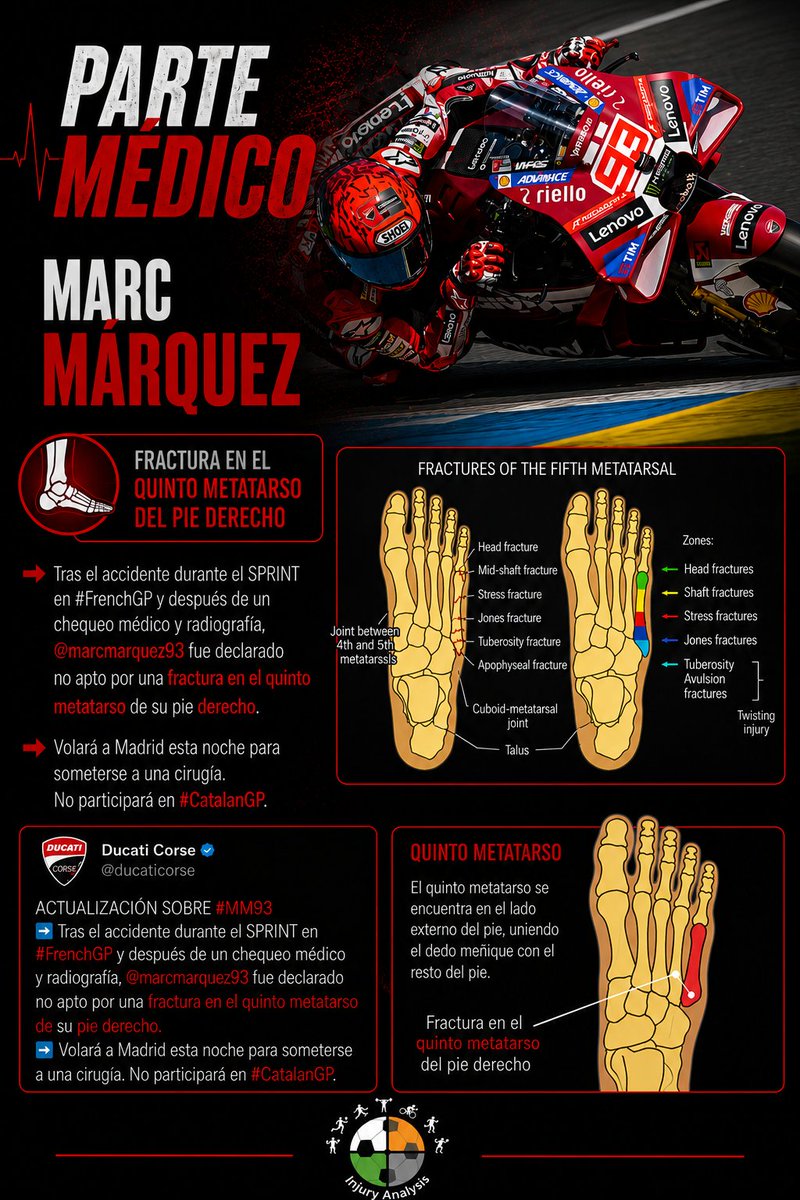 Analysis_Injury's tweet photo. 🚨 Contratiempo para Marc Márquez.

Tras una caída en la carrera al sprint de #FrenchGP, el piloto español tiene una fractura en el quinto metatarsiano  del pie derecho.

Necesitará cirugía para resolverla y se pierde, al menos, el próximo Gran Premio. https://t.co/oFXTV0eP7Z