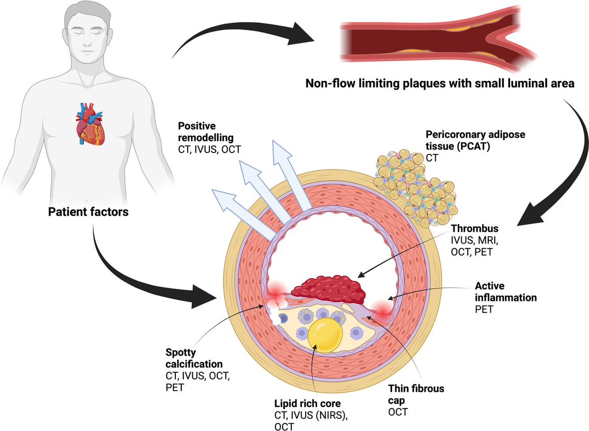 Identification and management of non-obstructive high-risk coronary artery plaque

Please read the article and enjoy an in-depth interview between <a href="/jhfrudd/">James Rudd</a> and the first author, University of Edinburgh's Dr Craig Balmforth

Publication - bit.ly/4dHJwJd

Podcast -