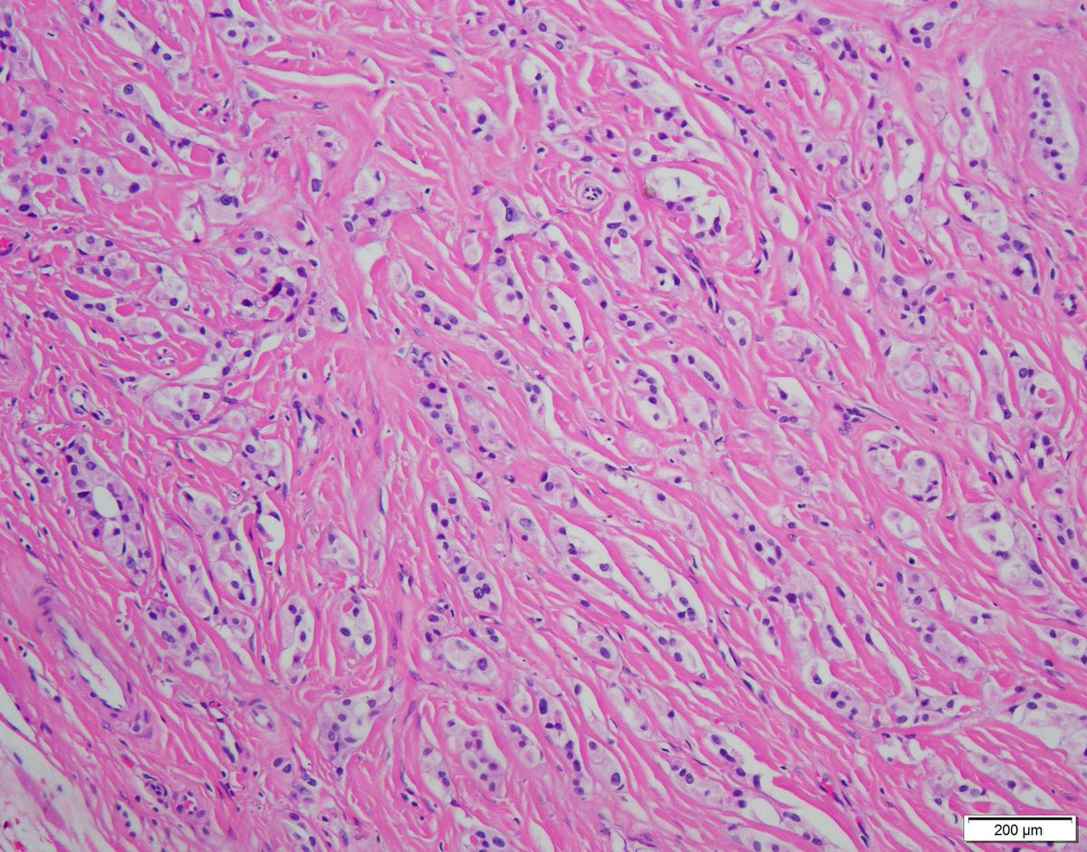 DrCycloPath's tweet photo. ✅ Sertoli Cell Tumor 🎯🔬
• Composed of Sertoli cells arranged in hollow or solid tubules and cords
• Features a variable, sometimes exuberant, sclerotic or myxoid stroma
• Driven by CTNNB1 gene mutations in 60–70% of cases
• Nuclear beta-catenin IHC is a highly characteristic diagnostic finding reflecting this mutation