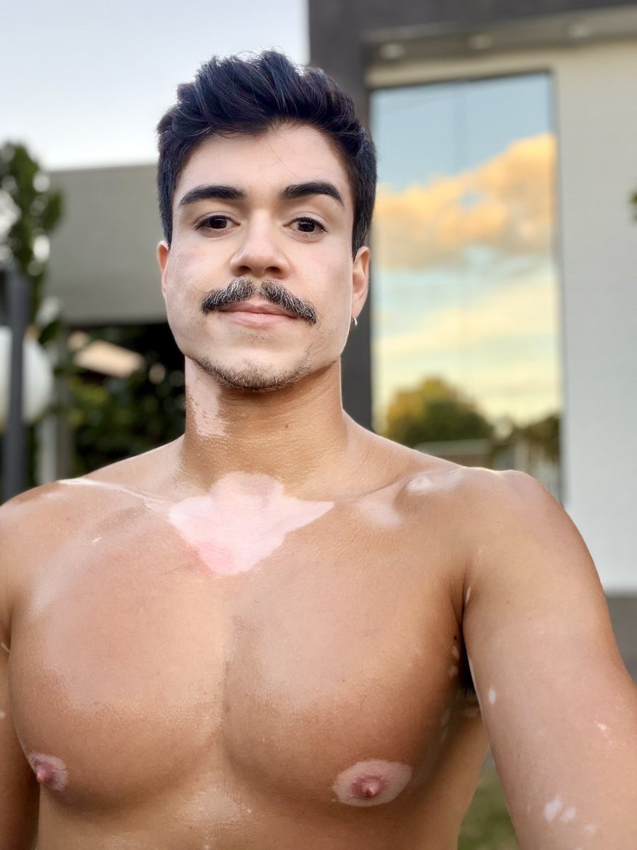 vitiligo performático 🤪 tweet media