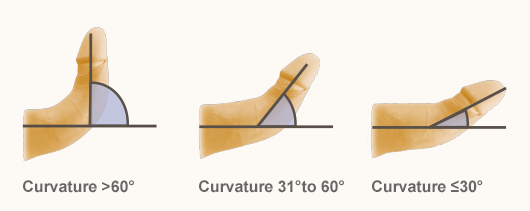 Eh07694377's tweet photo. @bullyoblivious @Juliander_X45er @Karawontmiss Yes inherently you dip shit. 30° is still extreme and a slight curve like the one in the blue picture is healthy and normal, stop spreading misinformation, there is nothing special about your straight micro penis. https://t.co/3tbPMoXgGn