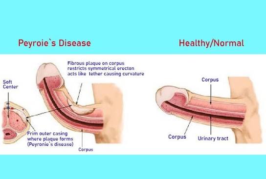 Eh07694377's tweet photo. @bullyoblivious @Juliander_X45er @Karawontmiss Yes inherently you dip shit. 30° is still extreme and a slight curve like the one in the blue picture is healthy and normal, stop spreading misinformation, there is nothing special about your straight micro penis. https://t.co/3tbPMoXgGn