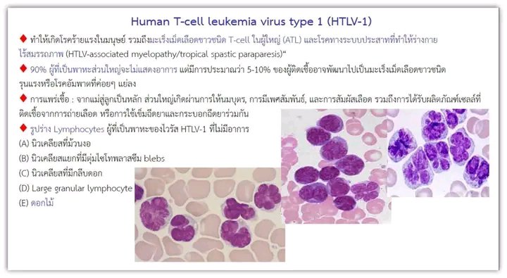 Mota55em's tweet photo. 🌸Lymphocytes “Flower Cell”🌸

✅ A lymphocyte with a nucleus resembling flower petals.
✅ Most commonly observed in Adult T-cell Leukemia/Lymphoma (ATLL), which is associated with HTLV-1 (Human T-lymphotropic virus type 1) infection.
✅ Considered a hallmark feature supporting the diagnosis of ATLL.

👉 Therefore, “Lymphocyte Flower Cell” = a Lymphocyte with a flower-like nucleus (most often seen in ATLL caused by HTLV-1 infection).

🌸Morphology 
✅ Cell size: Medium to large, larger than small mature lymphocytes.
✅ Nucleus: Polylobated/petaloid, with 3–6 lobes and deep indentations resembling petals (not shallow grooves like cerebriform nuclei).
✅ Chromatin: Coarse, hyperchromatic; nucleoli usually inconspicuous.
✅ Cytoplasm: Scant to moderate, sometimes mildly basophilic, with smooth borders.
✅ Other findings: Anisocytosis; increased numbers of flower cells in cases with lymphocytosis.

🌸Pitfalls & Differential Diagnosis (DDx)
🍀Sézary cell (CTCL/Sezary syndrome): Cerebriform nucleus with fine, shallow grooves; not lobulated.
🌺 Reactive/atypical lymphocyte (e.g., EBV/CMV): Large cells with abundant cytoplasm that often “embraces” RBCs; nucleus oval/irregular but not lobulated.
🌹Monocytes/Polymorphonuclear leukocytes: Presence of granules and granulocytic chromatin pattern distinguish them from lymphocytes.
💐Others: Occasionally, reactive multilobated lymphocytes may be seen, but when present in large numbers with clear petaloid shapes, ATLL should be strongly considered.

🌸Common Clinical/Laboratory Associations in ATLL
✅ Hematology: Lymphocytosis
✅ Clinical features: Skin rashes/lesions, lymphadenopathy, hepatosplenomegaly
✅ Biochemical findings: Hypercalcemia, elevated LDH
✅ Systemic involvement: May affect bone, skin, and other organs