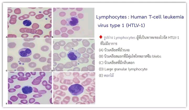 Mota55em's tweet photo. 🌸Lymphocytes “Flower Cell”🌸

✅ A lymphocyte with a nucleus resembling flower petals.
✅ Most commonly observed in Adult T-cell Leukemia/Lymphoma (ATLL), which is associated with HTLV-1 (Human T-lymphotropic virus type 1) infection.
✅ Considered a hallmark feature supporting the diagnosis of ATLL.

👉 Therefore, “Lymphocyte Flower Cell” = a Lymphocyte with a flower-like nucleus (most often seen in ATLL caused by HTLV-1 infection).

🌸Morphology 
✅ Cell size: Medium to large, larger than small mature lymphocytes.
✅ Nucleus: Polylobated/petaloid, with 3–6 lobes and deep indentations resembling petals (not shallow grooves like cerebriform nuclei).
✅ Chromatin: Coarse, hyperchromatic; nucleoli usually inconspicuous.
✅ Cytoplasm: Scant to moderate, sometimes mildly basophilic, with smooth borders.
✅ Other findings: Anisocytosis; increased numbers of flower cells in cases with lymphocytosis.

🌸Pitfalls & Differential Diagnosis (DDx)
🍀Sézary cell (CTCL/Sezary syndrome): Cerebriform nucleus with fine, shallow grooves; not lobulated.
🌺 Reactive/atypical lymphocyte (e.g., EBV/CMV): Large cells with abundant cytoplasm that often “embraces” RBCs; nucleus oval/irregular but not lobulated.
🌹Monocytes/Polymorphonuclear leukocytes: Presence of granules and granulocytic chromatin pattern distinguish them from lymphocytes.
💐Others: Occasionally, reactive multilobated lymphocytes may be seen, but when present in large numbers with clear petaloid shapes, ATLL should be strongly considered.

🌸Common Clinical/Laboratory Associations in ATLL
✅ Hematology: Lymphocytosis
✅ Clinical features: Skin rashes/lesions, lymphadenopathy, hepatosplenomegaly
✅ Biochemical findings: Hypercalcemia, elevated LDH
✅ Systemic involvement: May affect bone, skin, and other organs