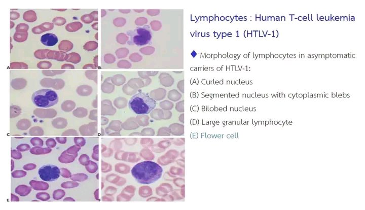 Mota55em's tweet photo. 🌸Lymphocytes “Flower Cell”🌸

✅ A lymphocyte with a nucleus resembling flower petals.
✅ Most commonly observed in Adult T-cell Leukemia/Lymphoma (ATLL), which is associated with HTLV-1 (Human T-lymphotropic virus type 1) infection.
✅ Considered a hallmark feature supporting the diagnosis of ATLL.

👉 Therefore, “Lymphocyte Flower Cell” = a Lymphocyte with a flower-like nucleus (most often seen in ATLL caused by HTLV-1 infection).

🌸Morphology 
✅ Cell size: Medium to large, larger than small mature lymphocytes.
✅ Nucleus: Polylobated/petaloid, with 3–6 lobes and deep indentations resembling petals (not shallow grooves like cerebriform nuclei).
✅ Chromatin: Coarse, hyperchromatic; nucleoli usually inconspicuous.
✅ Cytoplasm: Scant to moderate, sometimes mildly basophilic, with smooth borders.
✅ Other findings: Anisocytosis; increased numbers of flower cells in cases with lymphocytosis.

🌸Pitfalls & Differential Diagnosis (DDx)
🍀Sézary cell (CTCL/Sezary syndrome): Cerebriform nucleus with fine, shallow grooves; not lobulated.
🌺 Reactive/atypical lymphocyte (e.g., EBV/CMV): Large cells with abundant cytoplasm that often “embraces” RBCs; nucleus oval/irregular but not lobulated.
🌹Monocytes/Polymorphonuclear leukocytes: Presence of granules and granulocytic chromatin pattern distinguish them from lymphocytes.
💐Others: Occasionally, reactive multilobated lymphocytes may be seen, but when present in large numbers with clear petaloid shapes, ATLL should be strongly considered.

🌸Common Clinical/Laboratory Associations in ATLL
✅ Hematology: Lymphocytosis
✅ Clinical features: Skin rashes/lesions, lymphadenopathy, hepatosplenomegaly
✅ Biochemical findings: Hypercalcemia, elevated LDH
✅ Systemic involvement: May affect bone, skin, and other organs