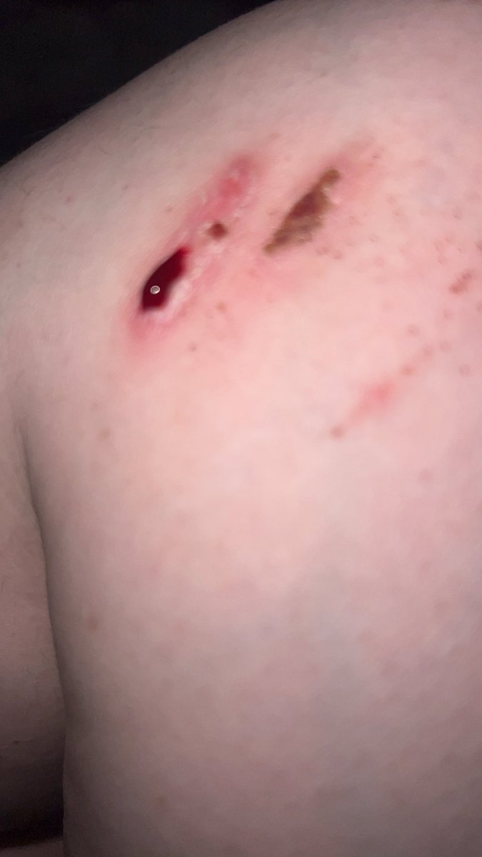 RydenRyRoBeebo's tweet photo. My scab peeled. well not on its own. I peeled it. Peeling scabs feels so good. #sh #scabs #blood #mentalhealth https://t.co/ytoGjqvJQw
