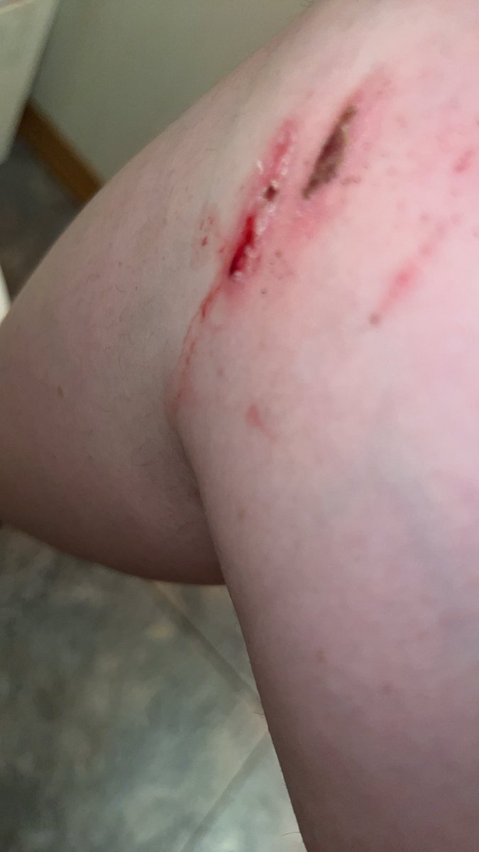 RydenRyRoBeebo's tweet photo. My scab peeled. well not on its own. I peeled it. Peeling scabs feels so good. #sh #scabs #blood #mentalhealth https://t.co/ytoGjqvJQw