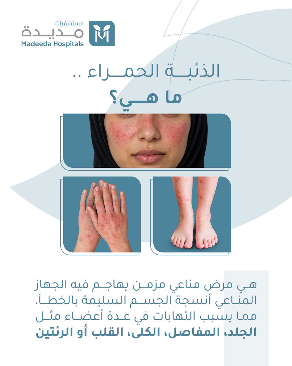 MadeedaHospital's tweet photo. الذئبة الحمراء ..
مرض مناعي مزمن يهاجم أنسجة الجسم السليمة وقد يؤثر على الجلد والمفاصل والكلى.

التشخيص المبكر والمتابعة الطبية يساعدان في السيطرة على الأعراض وتحسين جودة الحياة.

💜 لا تتجاهل الأعراض واطمئن على صحتك.

#مستشفيات_مديدة 
#اليوم_العالمي_للذئبة_الحمراء
#الذئبة_الحمراء 
#مستشفيات_الرياض