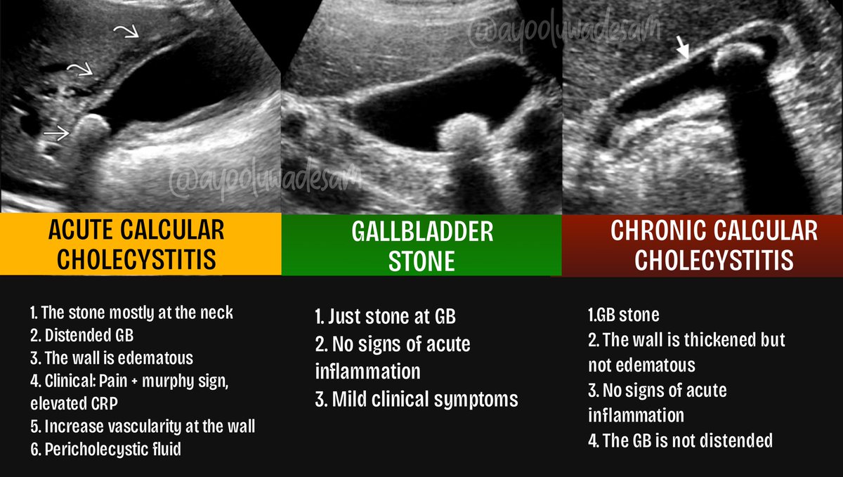 ayooluwadesam's tweet photo. These are 3 different diagnoses related to the gallbladder. Very simple to understand so you don't mix them up in the future. 

1.  GB stone : Just stone. 

2. Acute calcular cholecystitis: Stone + acute inflammation.

3. Chronic caclular cholecystitis: Stone + chronic inflammation.