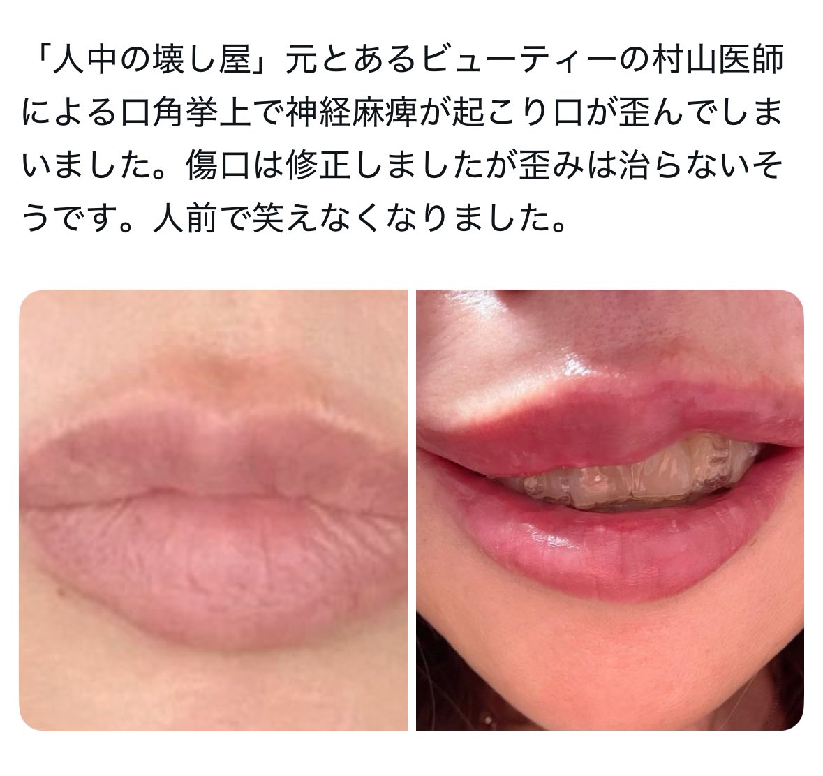 ganmen_update_'s tweet photo. 早速情報ありがとうございます🙇🏻‍♀️
次は新宿のピオー◯クリニックにいます。
⚠️要注意⚠️#人中短縮 #口角挙上 #唇形成
2枚目の方以外にも被害多発して前のクリニック辞めてます。どうか気をつけてください。
#拡散希望🔁 https://t.co/89Xlk4e6Yh