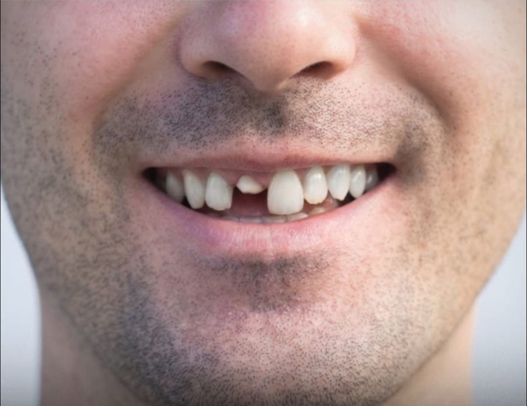🦷 Le Japon teste actuellement sur des humains un traitement expérimental capable de faire repousser des dents 😳

Des chercheurs travaillent sur un médicament ciblant une protéine appelée USAG-1, impliquée dans le développement des dents.

Le but est de permettre au corps de
