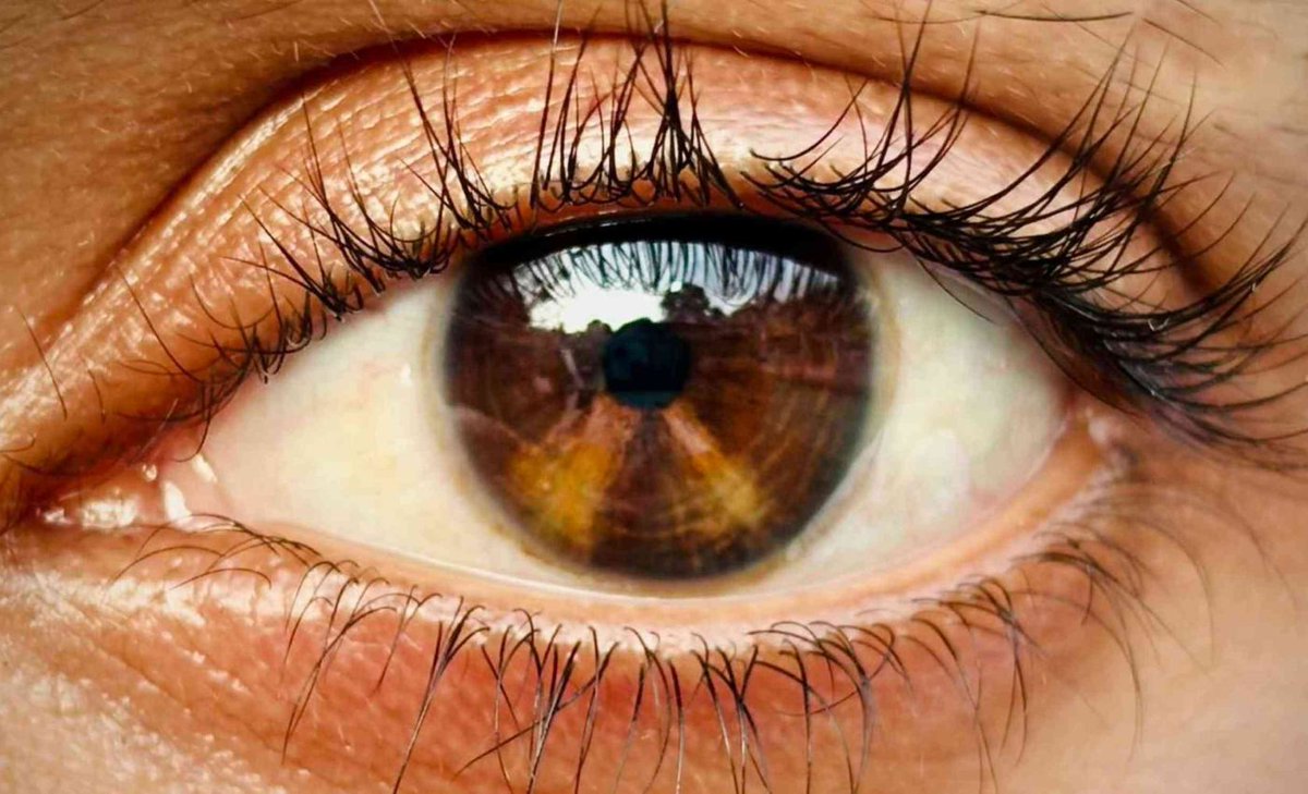 Analytics_699's tweet photo. A light-sensitive injection into the 👁 can trigger early vision-related signals in people with severely damaged retinas

The finding raises a precise possibility: even after the eye’s main light sensors fail, surviving cells may still carry signals toward the brain▶️
#AI #MedTwitter
https://t.co/VHzKXGjdCw