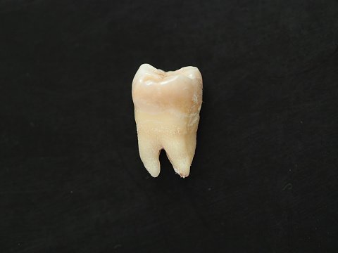 docakx's tweet photo. A tooth was found in a child's MRI scan. 

Which syndrome? https://t.co/H7BxoKfzci